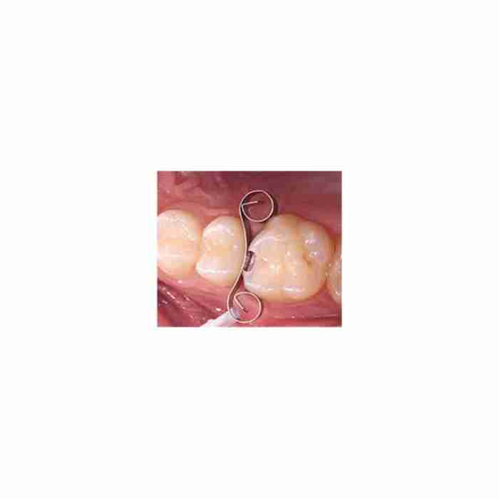 Ultradent Matrici Interguard 5x4mm + 5x5,5mm - immagine 1